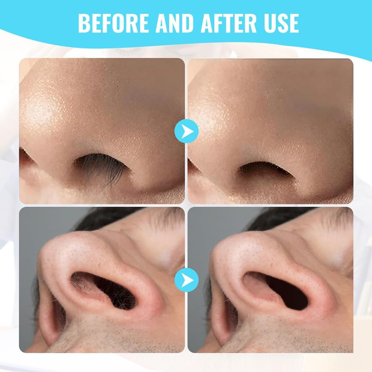 PSKZNSZ 5 Pcs Manual Nose Hair Trimmer, 2-In-1 Double-Sided Nostril | Hair Remov